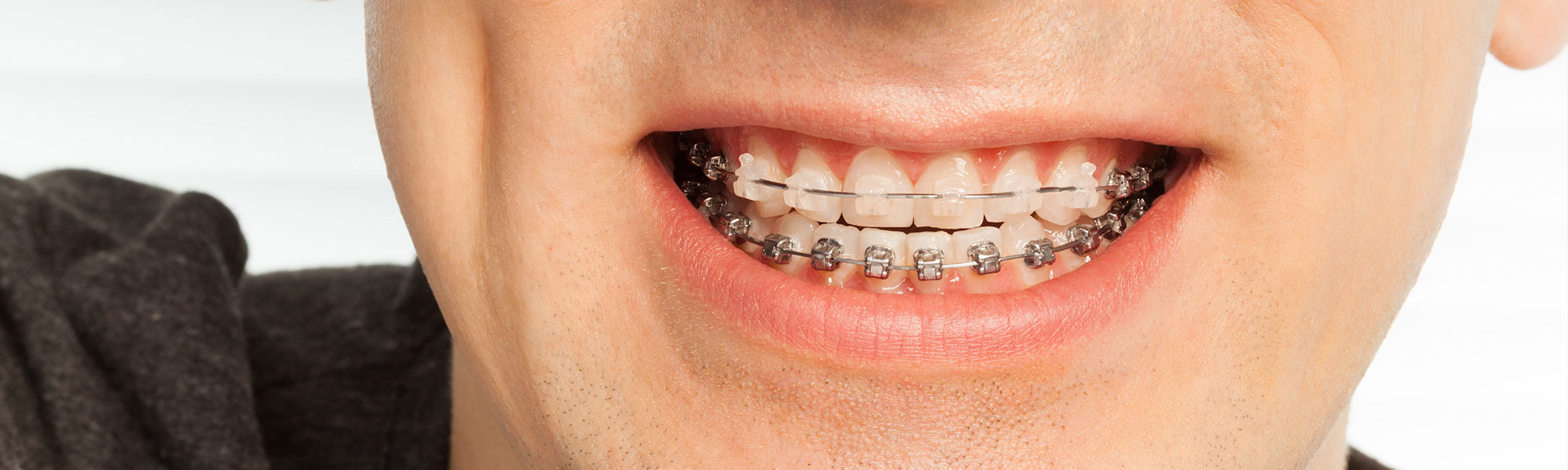 Porcelain Ceramic Braces Treatment in Long Beach CA