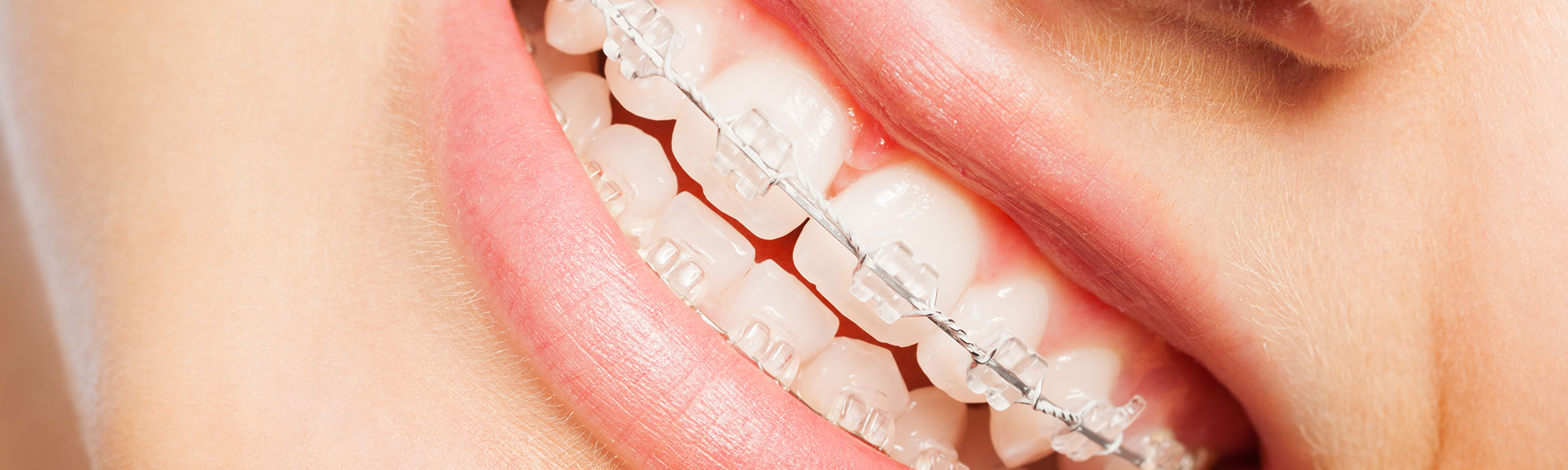Porcelain Ceramic Braces in Long Beach CA