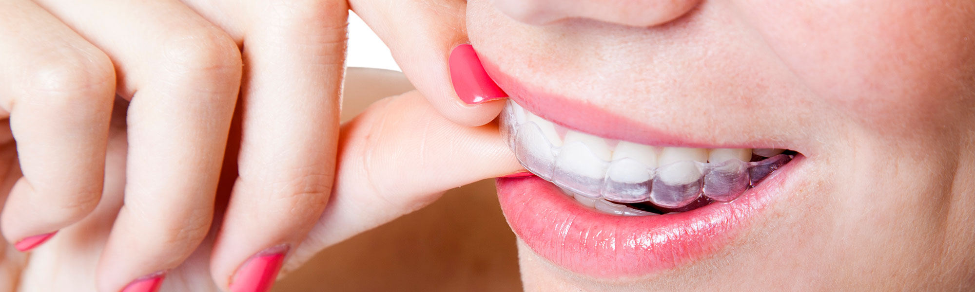 Orthodontics Retainers Long Beach CA